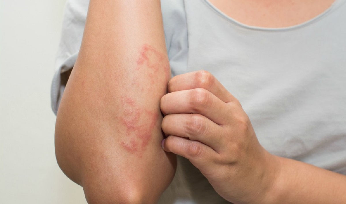 Estudo da Pfizer mostra desconhecimento da população acerca da dermatite atópica