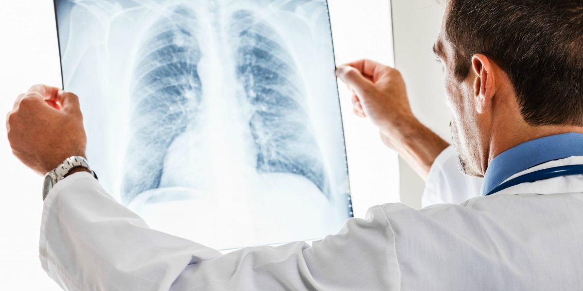 Farmacêuticas se unem para projeto de diagnóstico de câncer de pulmão
